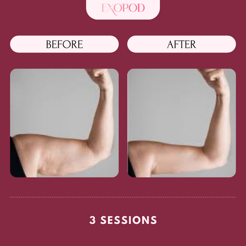 Copy of Exopod Before_After 3