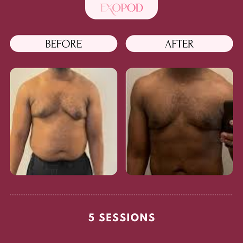 Copy of Exopod Before_After 4