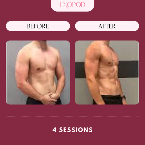 Copy of Exopod Before_After 5